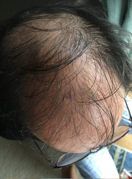 施術事例のBEFORE画像