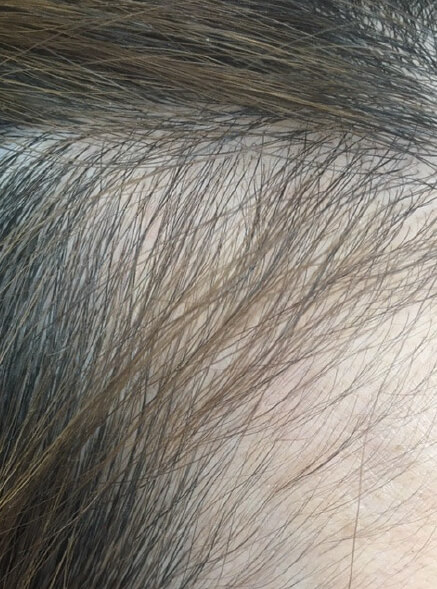 施術事例のBEFORE画像