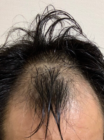 施術事例のBEFORE画像