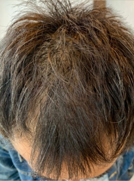 施術事例のBEFORE画像