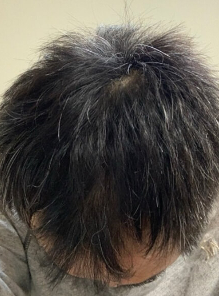 施術事例のAFTER画像